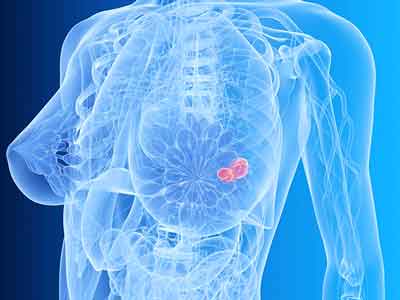 Breast Care